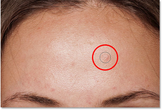 Positioning the Spot Healing Brush over a skin blemish to remove it